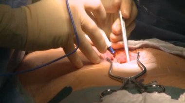 Cerrah elektrokoter kullanır