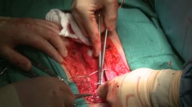 Dikiş göğüs kesi