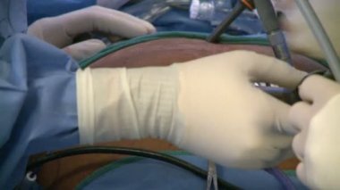 Çalışan laparascopic ameliyat sırasında el