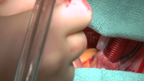 Surgeons perform open heart surgery — Stock Video