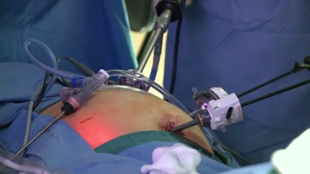Хірурги, що проводять медичну операцію — стокове відео