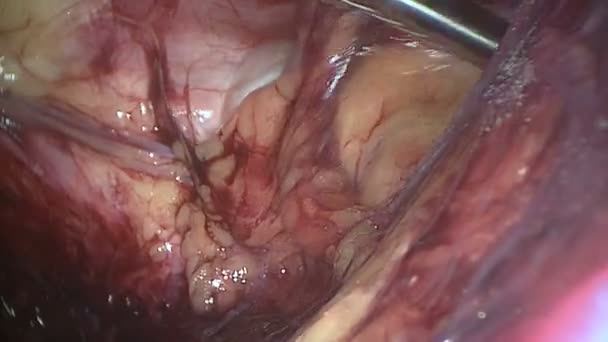 Chirurgen navigeren langs weefsel tijdens laparoscopie — Stockvideo