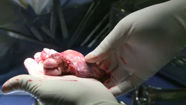 Robotic excision of the uterus — Stock Video