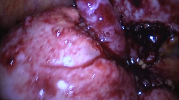 Infection surrounds a ruptured appendix — Stock Video