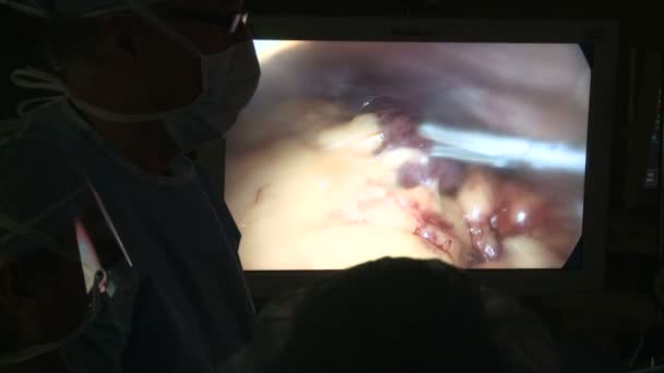 Kirurgiska team utföra laparoskopi — Stockvideo