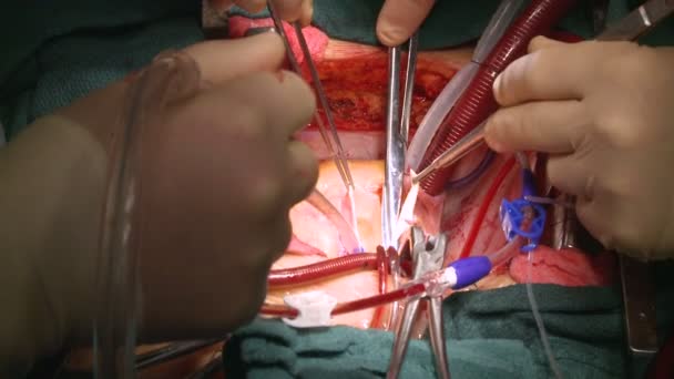 Surgeon's hands during operation — Stock Video