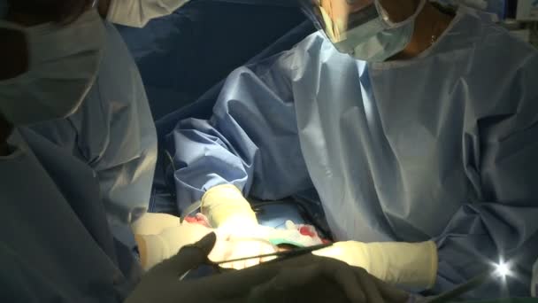 Chirurgii efectuează o operație medicală — Videoclip de stoc