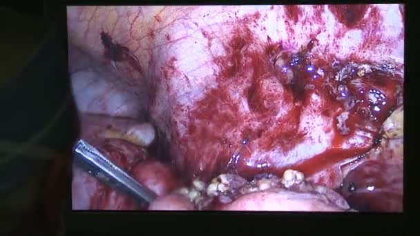 Infection entourant une rupture de l'appendice — Video