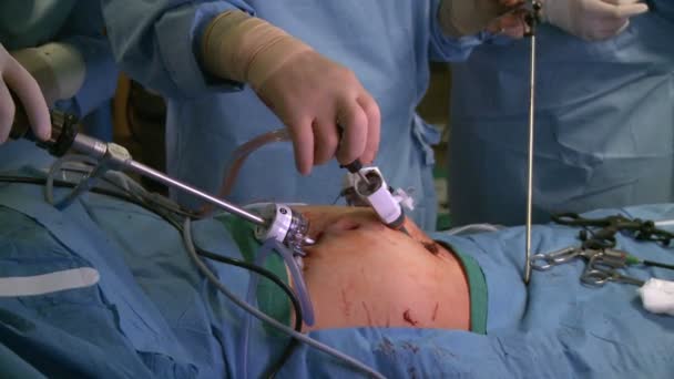 Mãos de cirurgiões durante cirurgia laparascópica — Vídeo de Stock