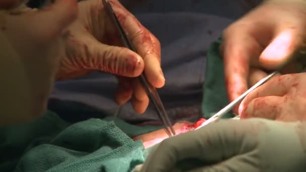 Cirujano cosiendo el abdomen — Vídeo de stock