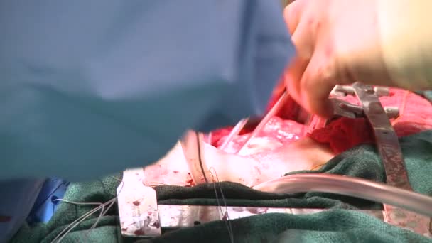 Trubky jsou umístěny během operace — Stock video
