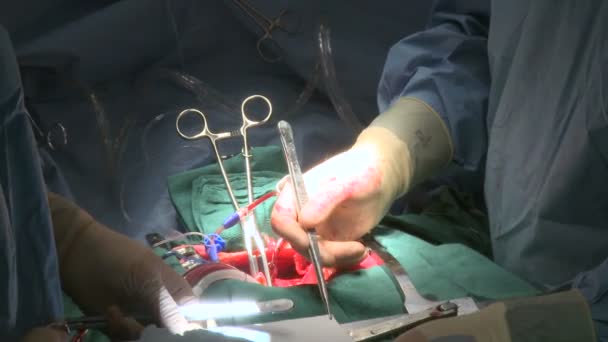 Surgeons work together on heart patient — Stock Video