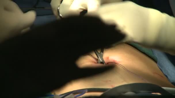Equipamentos laparoscópicos são inseridos para cirurgia — Vídeo de Stock