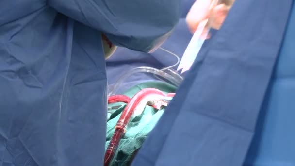 Tüpler açık kalp cerrahisi hasta üzerinden atlamak — Stok video