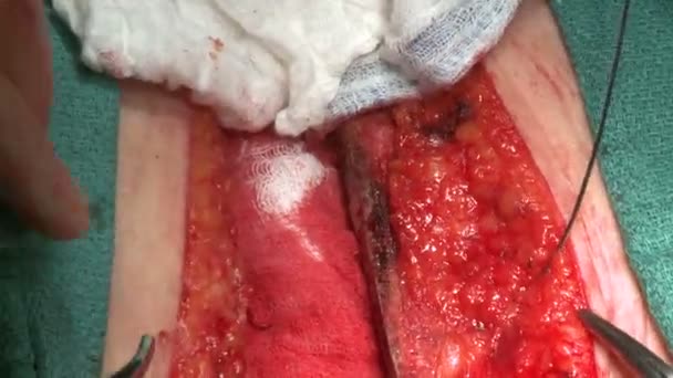 Sutura de incisión torácica — Vídeos de Stock