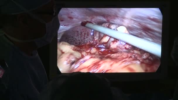 Хирург, выполняющий медицинскую операцию — стоковое видео