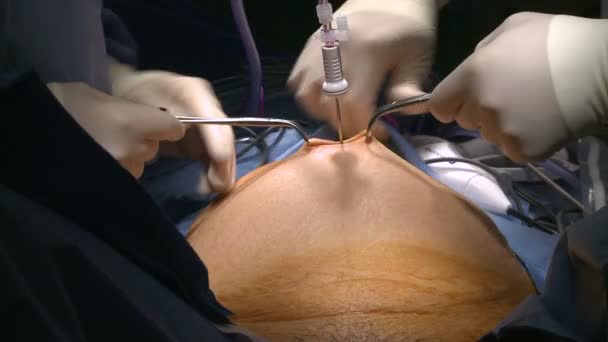 Chirurgie robotique de l'utérus — Video