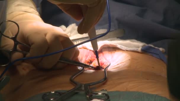 Kraakbeen verwijderen tijdens hartoperatie — Stockvideo