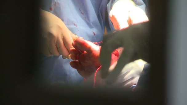 Surgeons performing a medical operation — Stock Video