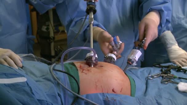 Chirurgiens mains pendant la chirurgie laparascopique — Video