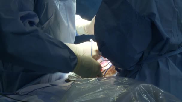 Surgeons perform the operation — Stock Video