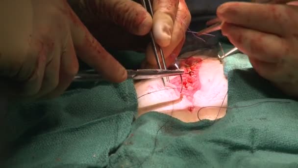 Cirujano cosiendo el abdomen — Vídeos de Stock