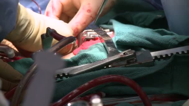 Surgeons performing a medical operation — Stock Video