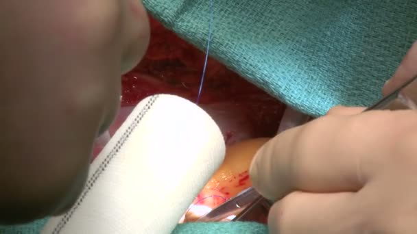 Хирурги проводят операцию на открытом сердце — стоковое видео