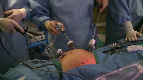 Руки хирургов во время лапароскопической операции — стоковое видео