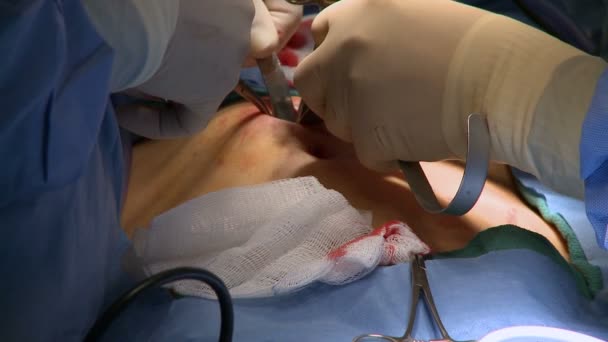 Хірурги, що проводять медичну операцію — стокове відео