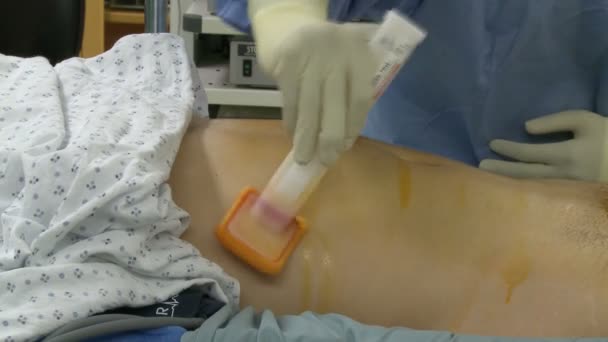 Abdômen do paciente está preparado para cirurgia — Vídeo de Stock