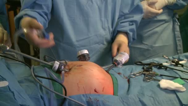 Руки хирургов во время лапароскопической операции — стоковое видео