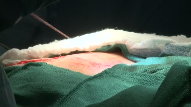 Le chirurgien effectue les derniers points de suture — Video