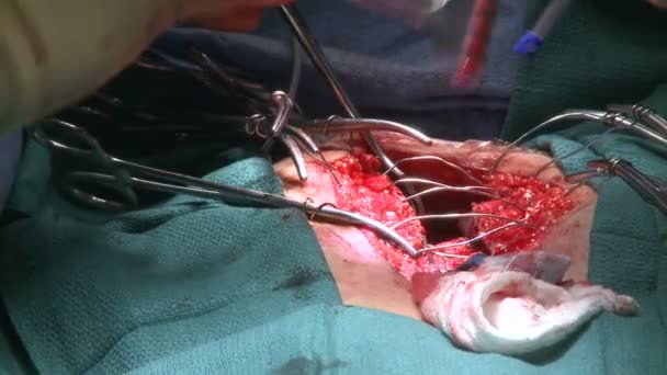 Electrocautery of chest incision — Stock Video