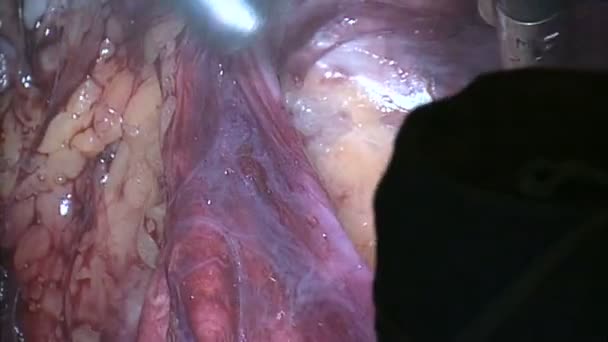 Surgeons navigate past tissue during laparoscopy — Stock Video
