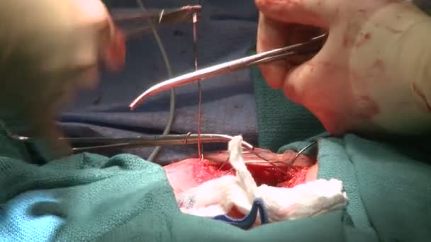 Chirurg pomocí drátu šít hrudní koš — Stock video