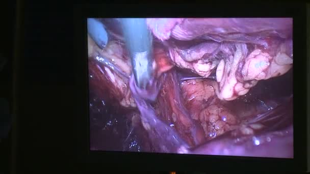 腹腔鏡検査中に使用されるビデオ モニター — ストック動画