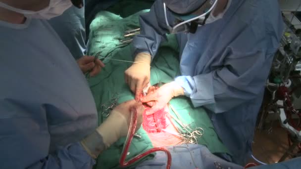 Sutura de incisión torácica — Vídeo de stock