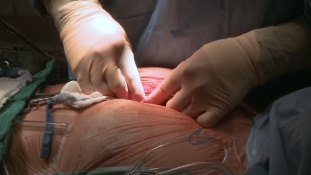 Surgeon cleaning rib retractor — Stock Video