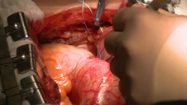 Artsen uitvoeren chirurgie op het kloppend hart in ziekenhuis — Stockvideo
