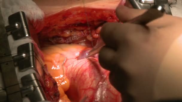 Doctors perform surgery on beating heart — Stock Video