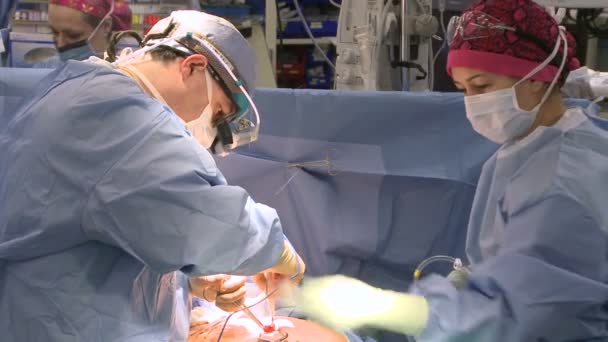 Extirpación de cartílago durante cirugía cardíaca — Vídeo de stock
