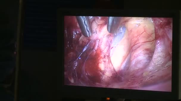 病院で腹腔鏡検査中に使用されるビデオ モニター — ストック動画