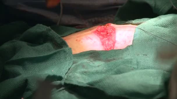 Surgeon stitching up abdomen — Stock Video