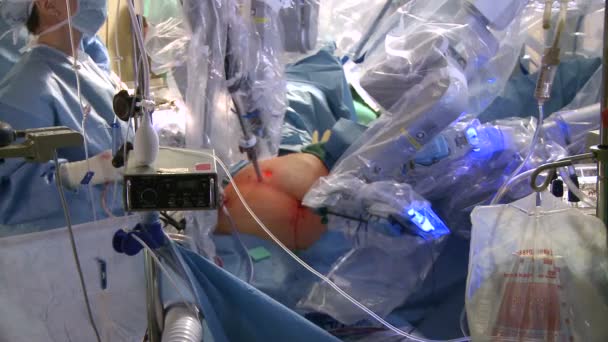 로봇 수술 장치 내부 작업의 보기 — 비디오