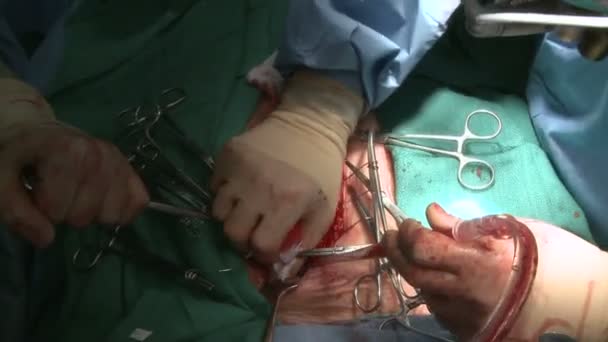 Sang aspiré pendant la chirurgie cardiaque — Video