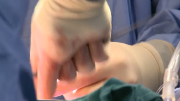 Surgeon's hands during operation — Stock Video