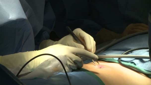 Laparoscopische apparatuur is voor chirurgie ingevoegd — Stockvideo