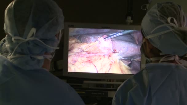 Monitor de vídeo usado durante a laparoscopia — Vídeo de Stock