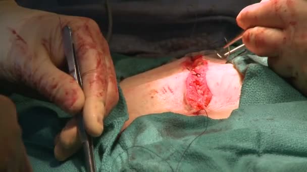 Хірург зшивання живота в лікарні — стокове відео